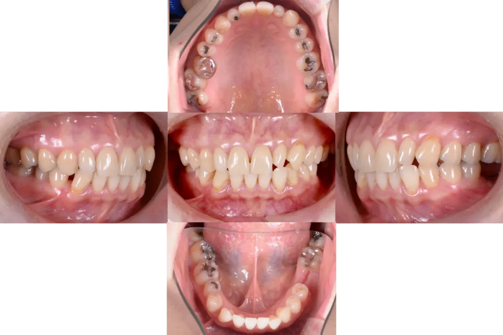 津田歯科矯正歯科case3before