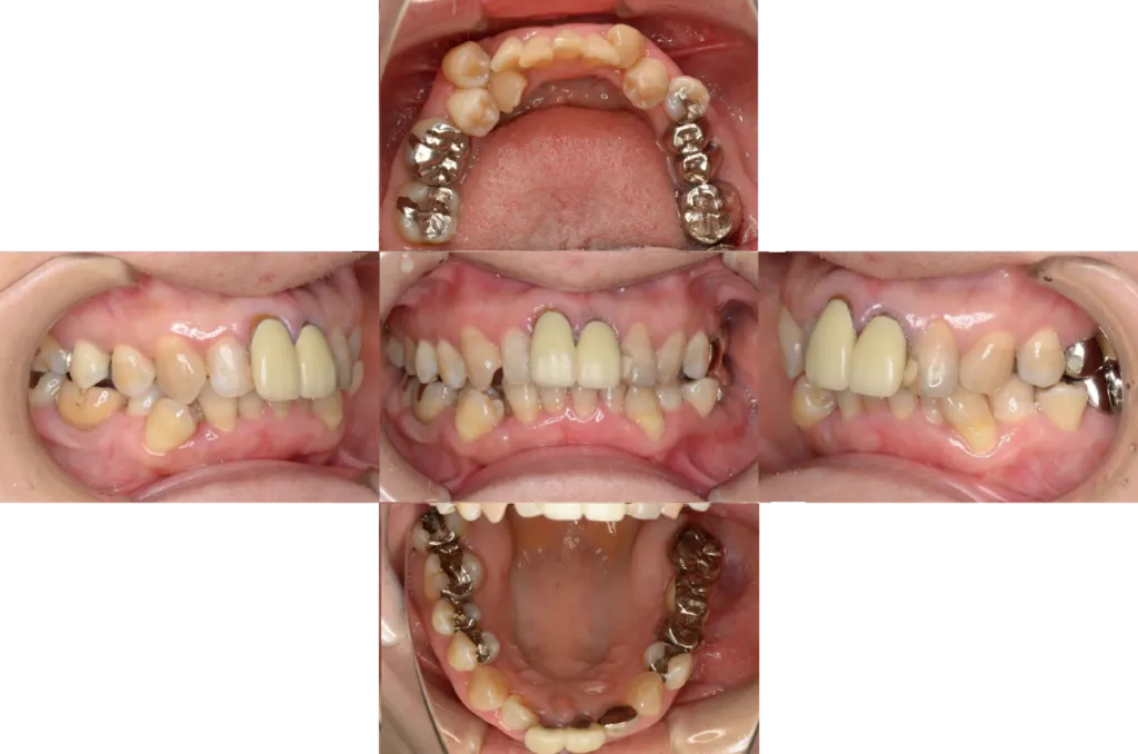 津田歯科矯正歯科case1 befor