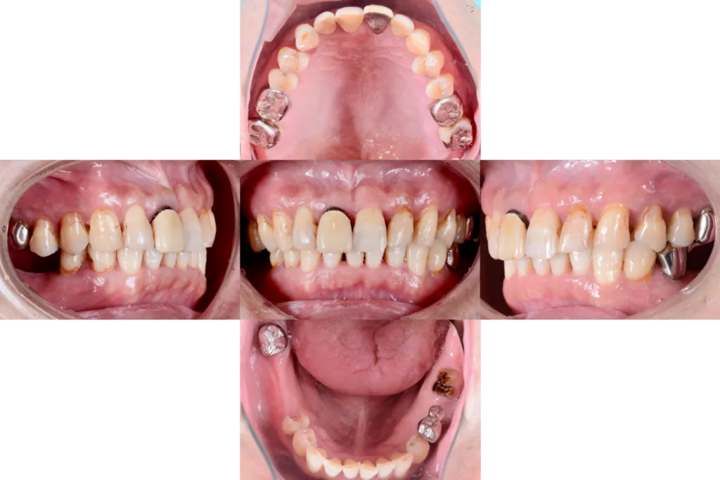 津田歯科矯正歯科case2before