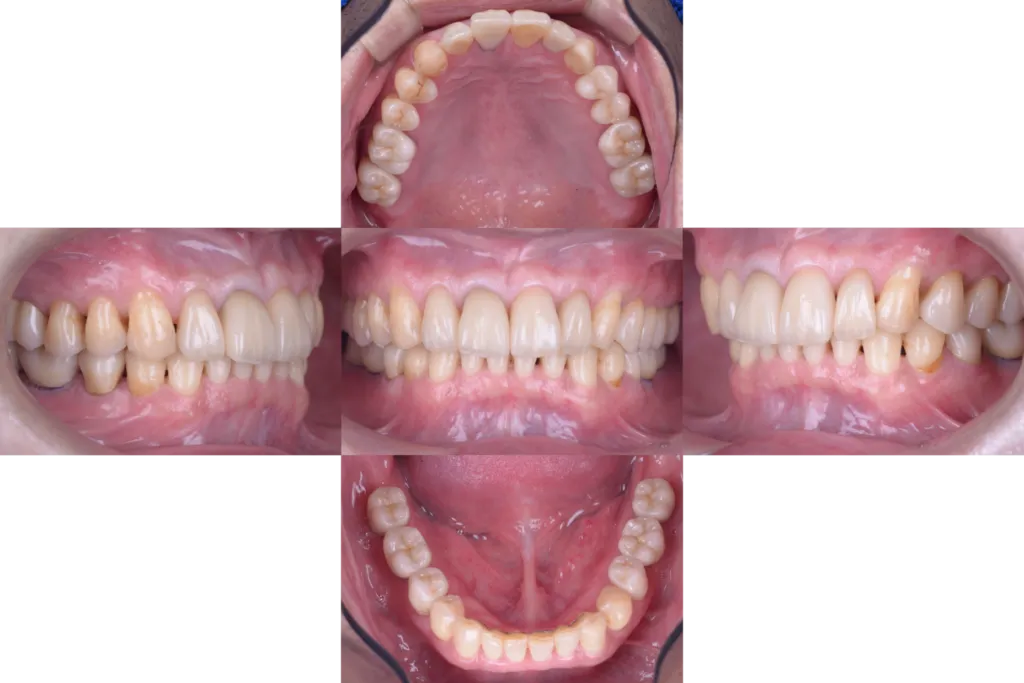 津田歯科矯正歯科case2after