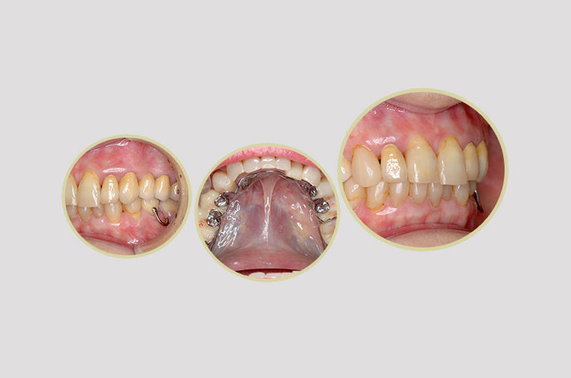 歯科技工士　奥森 健史 施術イメージ1