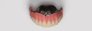 歯科技工士　奥森 健史 施術イメージ2