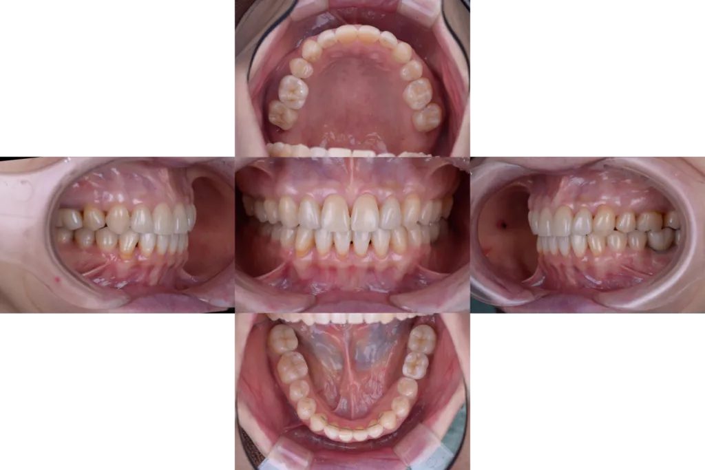 津田歯科矯正歯科case3after