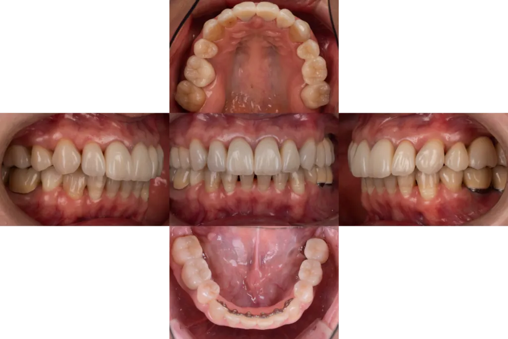 津田歯科矯正歯科case1after